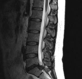 Diagnostické možnosti pro bederní osteochondózu