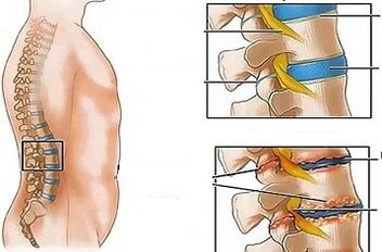 Důvody rozvoje bederní osteochondózy
