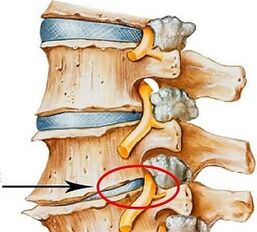 Proč je bederní osteochondrosis