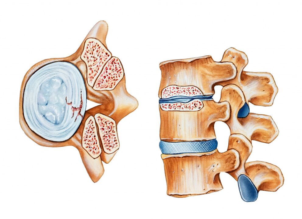 Osteochondrosis v oblasti děložního čípku vede ke zničení disků meziobratlových kotoučů