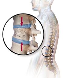 Osteoporóza vyvolává bolesti zad v dolní části zad